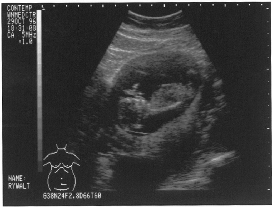 [Another Baby Ultrasound]